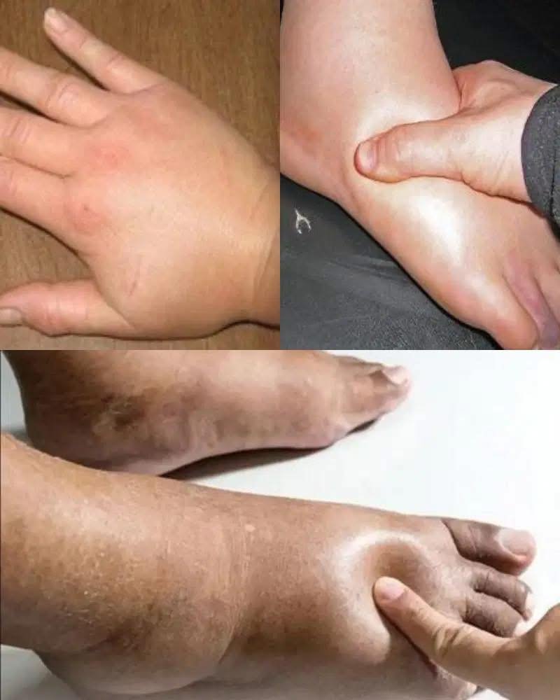 Get Rid of Swollen Hands & Feet Fast: Home Remedies for Water Retention